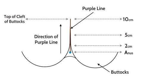 purple line dilation on dark skin